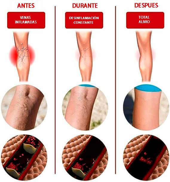 🩹 VariPatch – Elimina varices y mejora la circulación en solo 14 días