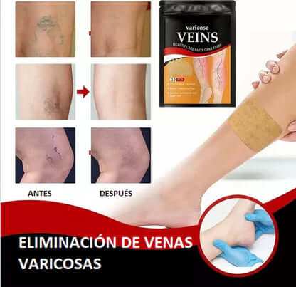 🩹 VariPatch – Elimina varices y mejora la circulación en solo 14 días